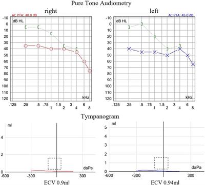 A novel homozygous RSPH4A variant in a family with primary ciliary dyskinesia and literature review